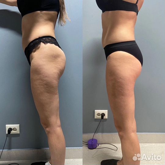 Коррекция фигуры, Вакуум, RF лифтинг, кавитация