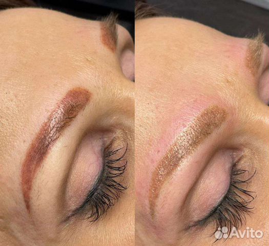 Удаление татуировок, татуажа