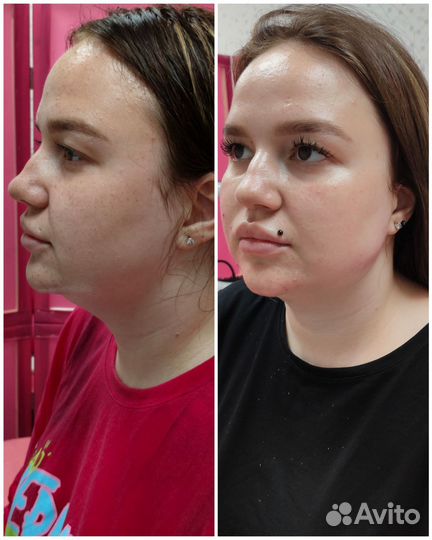 Контурная пластика лица