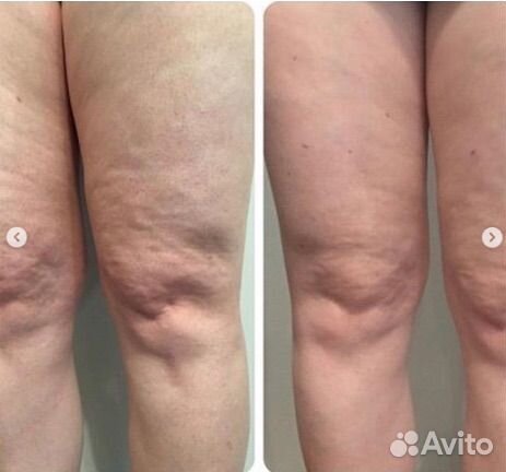 Массаж сферами