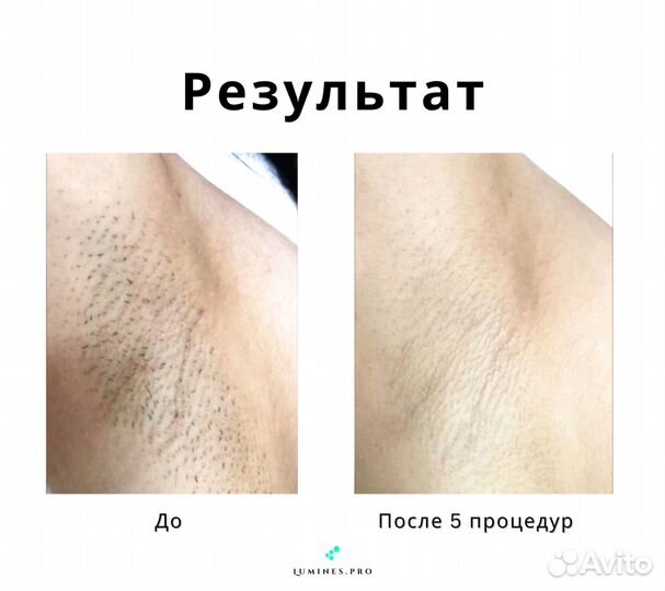 Диодный лазер для эпиляции Lumines Max One 1200W