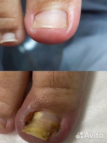 Вросший ноготь