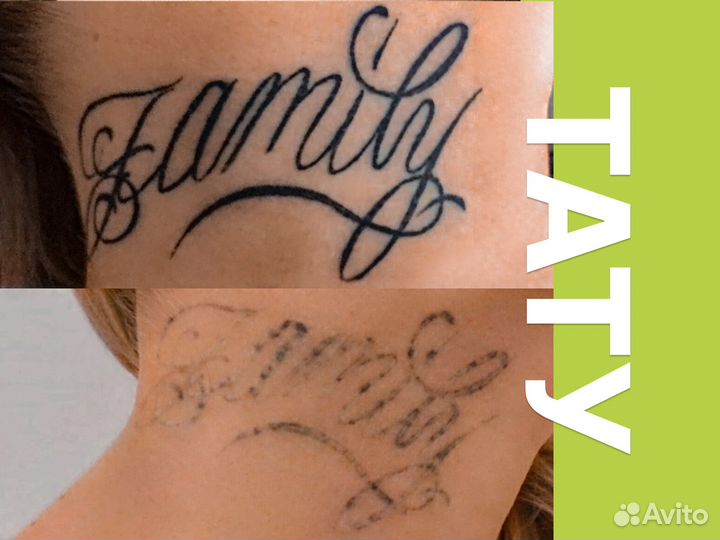 Лазерное удаление татуировок и татуажа