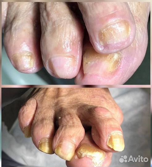 Подолог Педикюр Титановая нить