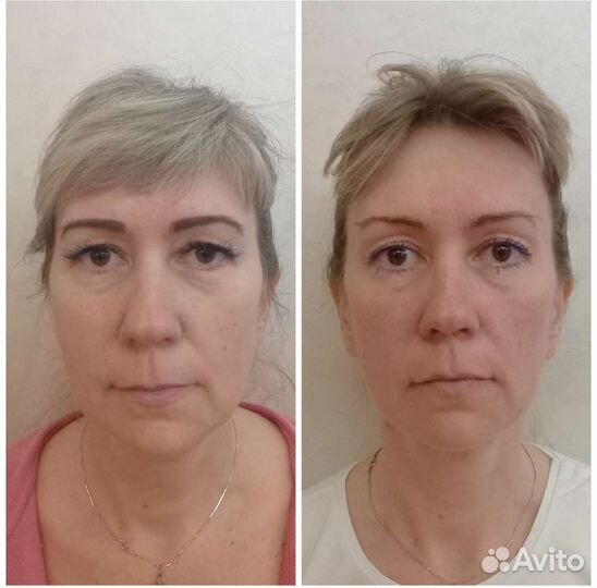 Витапластика. Массаж лица