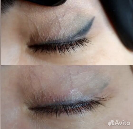 Удаление татуажа ремувером