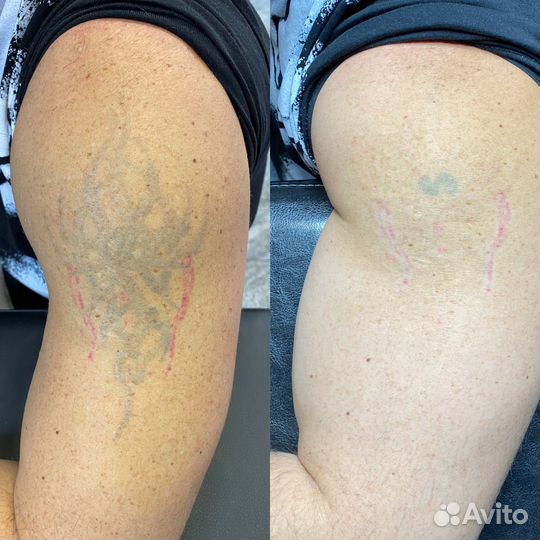 Удаление тату и татуажа