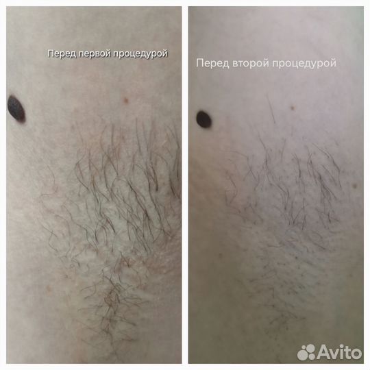 Электроэпиляция