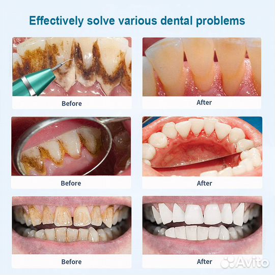 Ультразвуковой скалер для снятия зубного камня