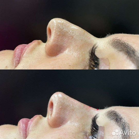 Безоперационная ринопластика