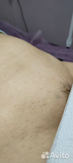 Электроэпиляция на аппарате Apilus/женская,мужская