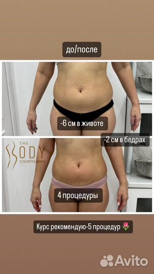 Процедура Индиба