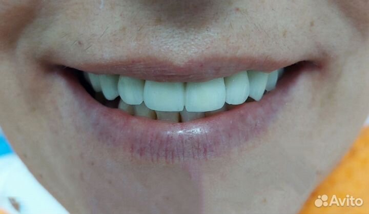 Коронки из металлокерамики