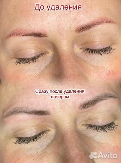 Удаление татуажа лазером