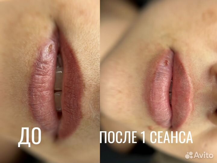 Удаление татуажа и тату