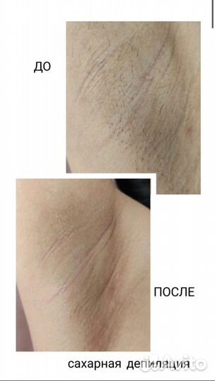 Шугаринг эпиляция