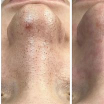 Косметолог чистка лица