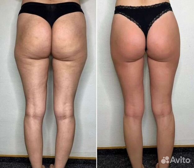 Антицеллюлитный массаж