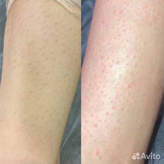 Электроэпиляция