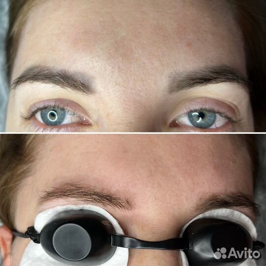 Лазерное удаление татуажа/тату