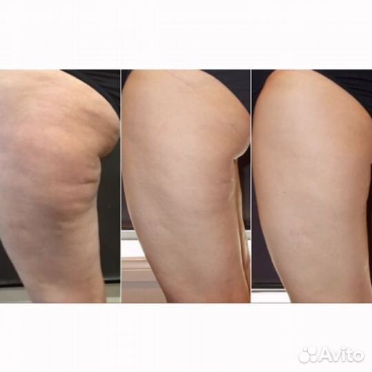 Антицеллюлитный массаж