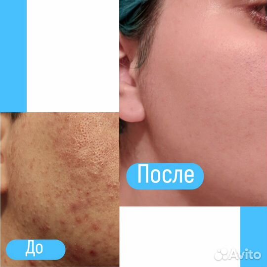 Удаление шрамов и рубцов