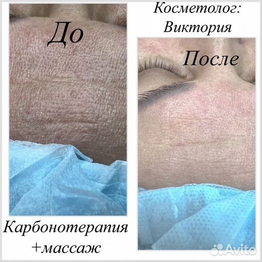 Карбонотерапия