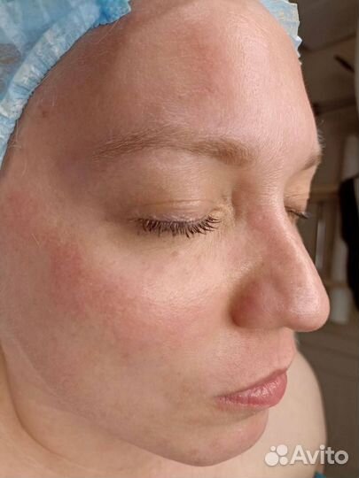 Чистка лица глубокий пилинг в подарок