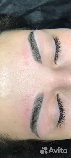 Лазерное удаление пм и татуировок