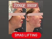 СМАС лифтинг SMAS lifting косметология пилинг