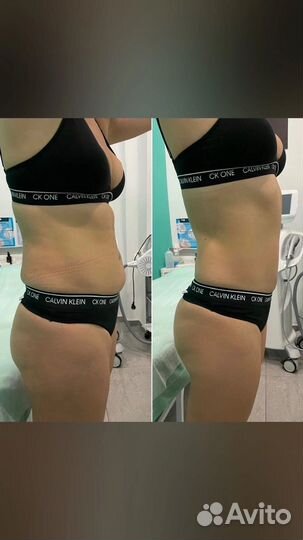 Антицеллюлитный массаж Ручной массаж