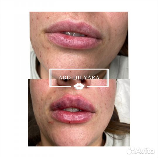 Увеличения губ/ косметолог