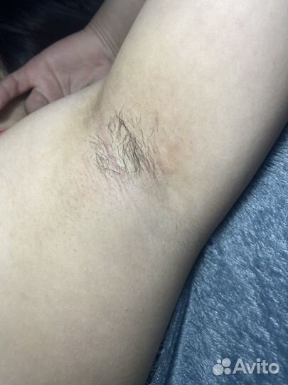 Электроэпиляция