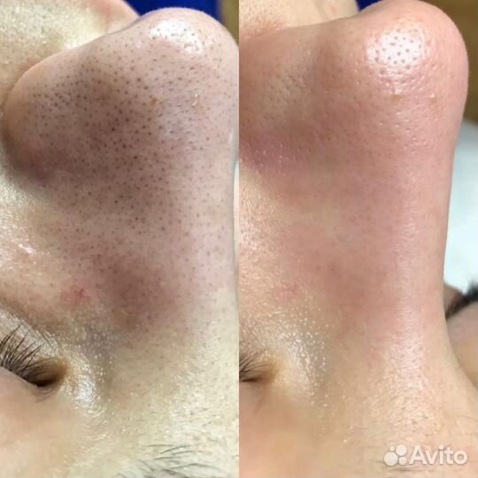 Модель на чистку лица