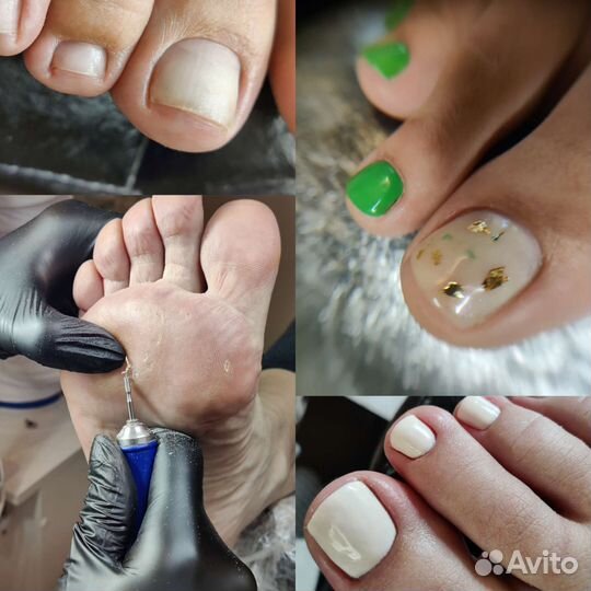 Педикюр, подологический педикюр