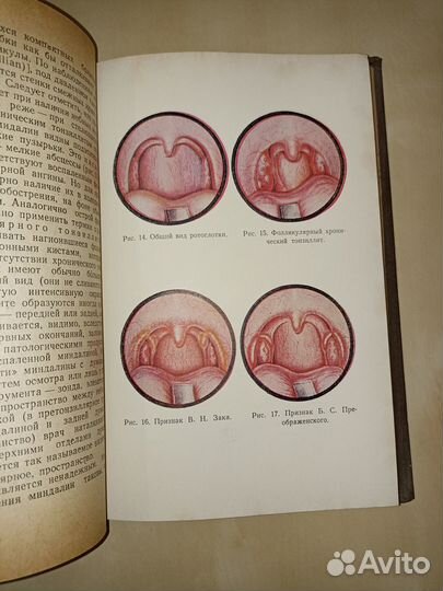 Хронический тонзиллит и его связь с другими заболе