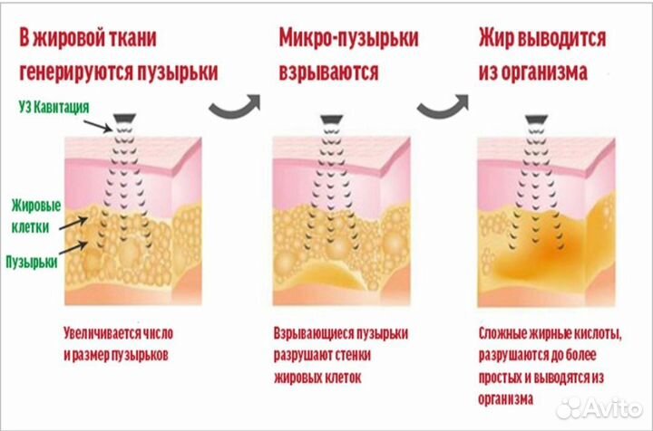 RF лифтинг Кавитация Вакуумный массаж