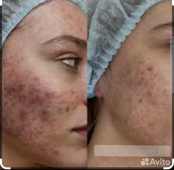 Чистка лица,пилинг,борьба с акне,постакне и др