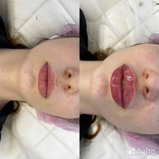 Увеличение губ контурная пластика губ косметолог