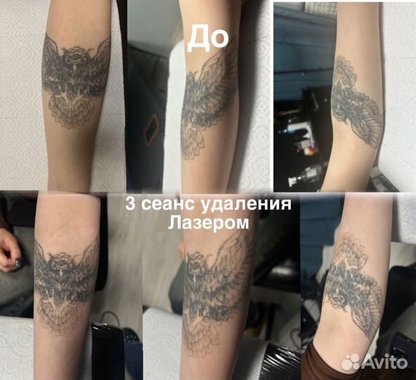 Лазерное удаление татуажа