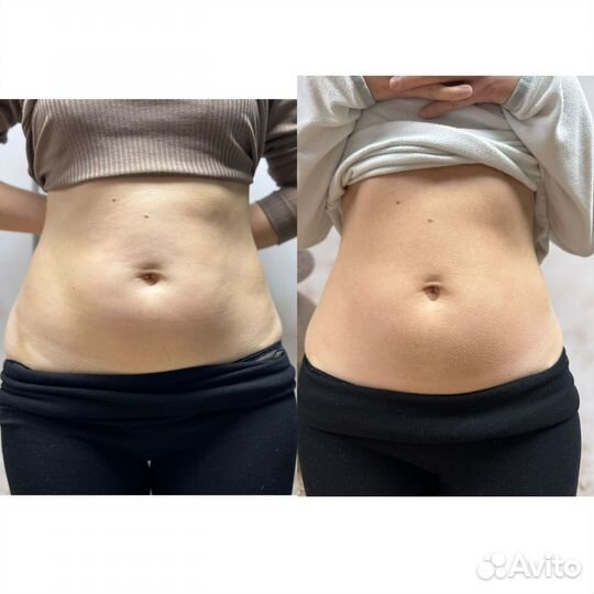 LPG лпг массаж