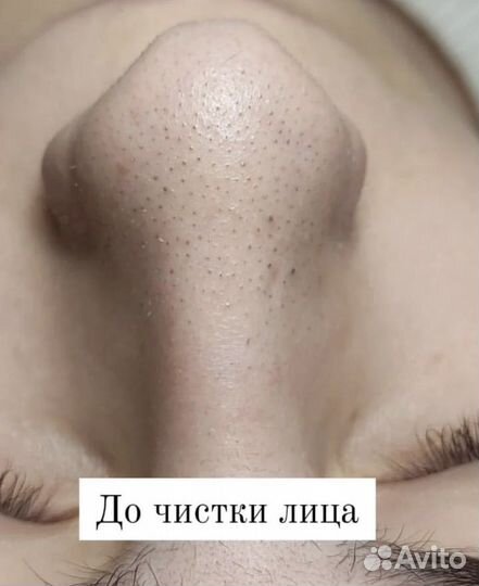 Чистка лица