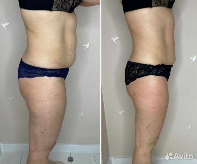 Аппаратный массаж/Ищу модель