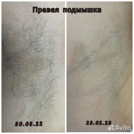 Электроэпиляция