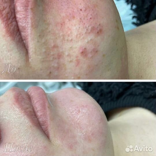 Модель на чистку лица