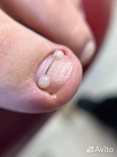 Медицинский педикюр, подолог