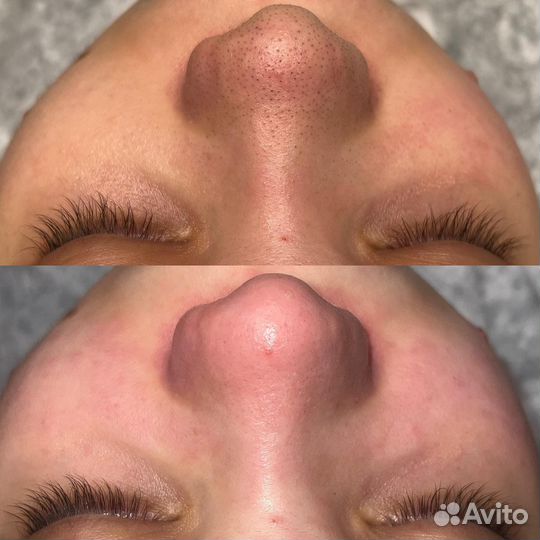 Модель на чистку лица