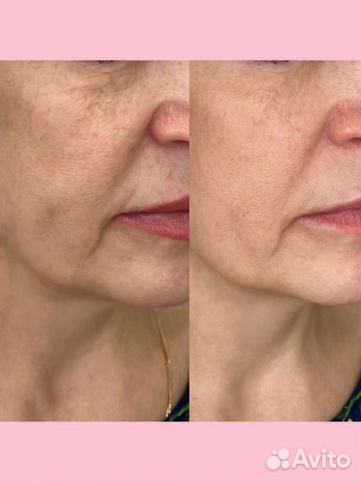 Комплекс Экспресс лифтинг