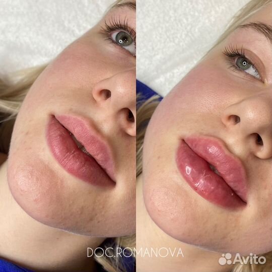 Косметолог. Увеличение губ