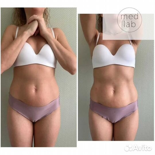 Аппарат mini Кавитация, липолазер, RF, вакуум